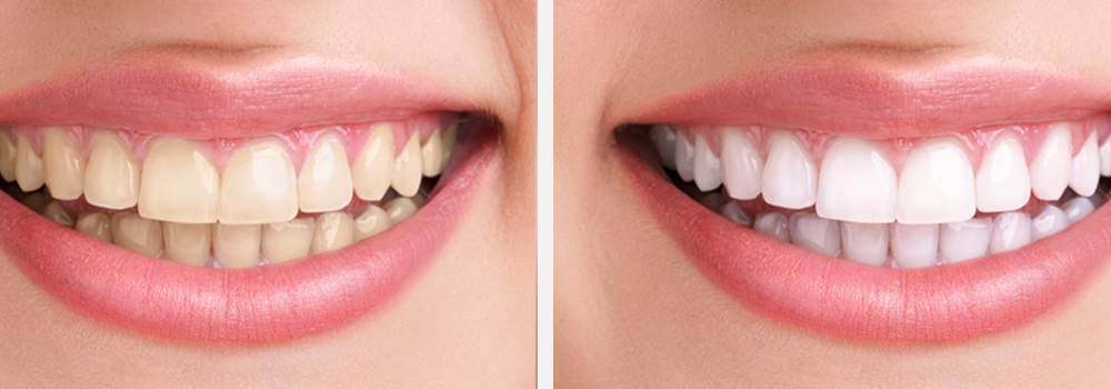 Teeth Whitening Packages